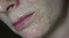 Demodecosis: co to je, symptomy a léčba