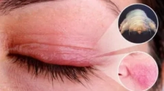 Demodecosis: příčiny, symptomy a léčba