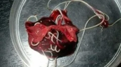 Červi v jaterní tkáně