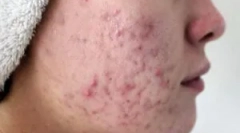 Jak je vysílána demodikóza?